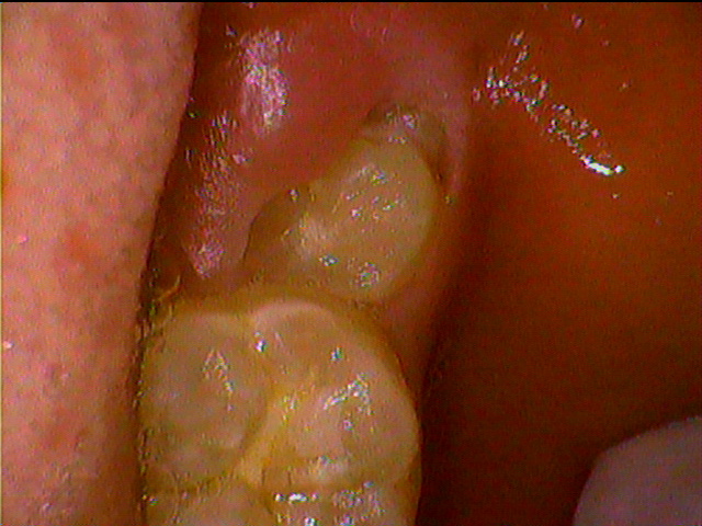 永久歯が生えてきて、歯茎が腫れてる？