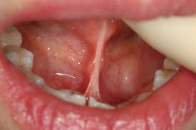 舌小帯