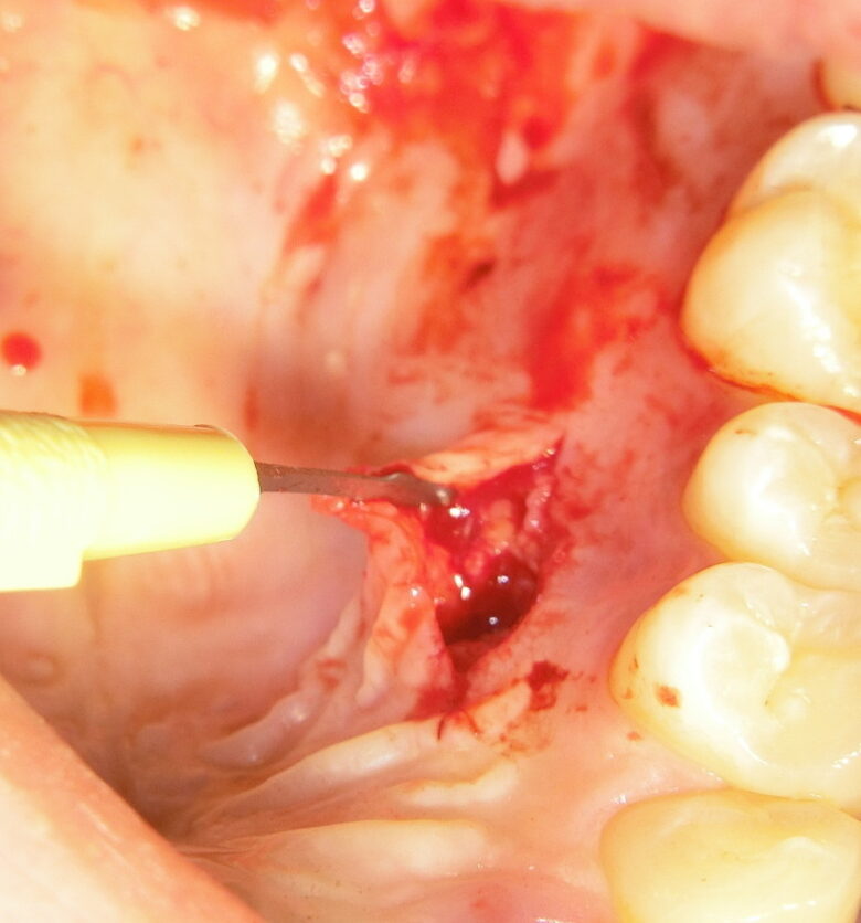 歯肉の移植