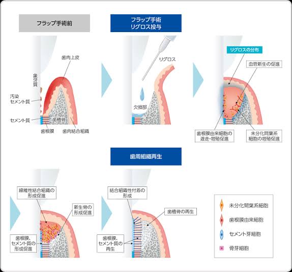 歯周組織再生