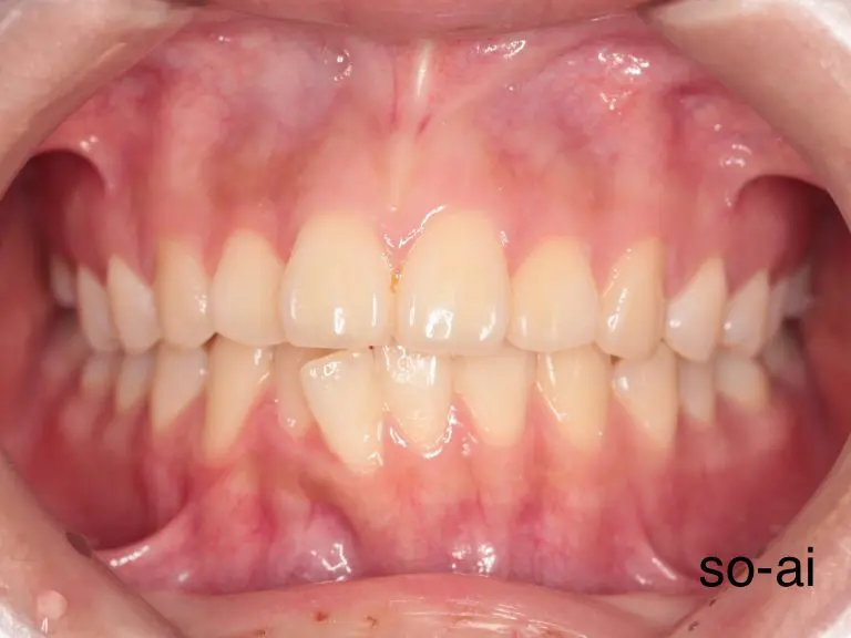治療前の歯の様子