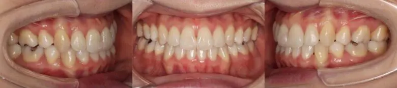 治療後の歯の様子