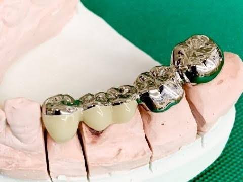ブリッジとは？失った歯を補う治療法をわかりやすく解説