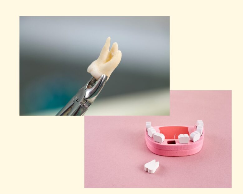 親知らずは全部抜く必要がある?